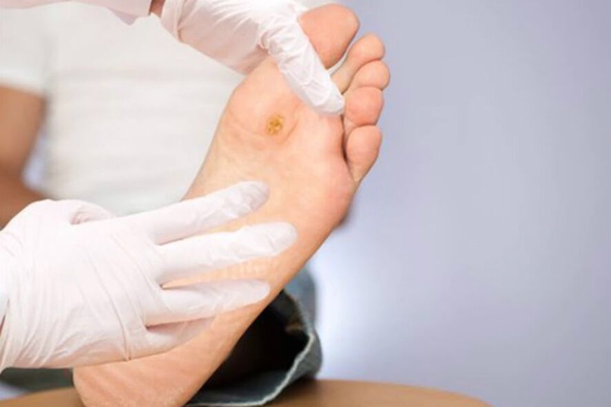 Diabetiker - schwere Komplikation von Diabetes